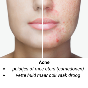 Acne huid